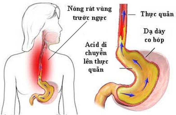 Trào ngược dạ dày là tình trạng axit, pepsin trong dạ dày bị đẩy ngược lên thực quản Trào ngược dạ dày là tình trạng axit, pepsin trong dạ dày bị đẩy ngược lên thực quản