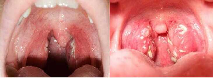 Viêm họng mãn tính với triệu chứng tấy đỏ và mưng mủ, sưng loét