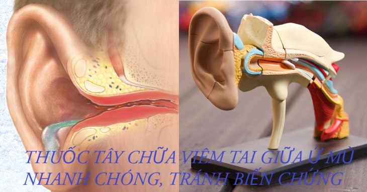 Chữa viêm tai giữa bằng thuốc là cách nhanh chóng nhất để khỏi bệnh