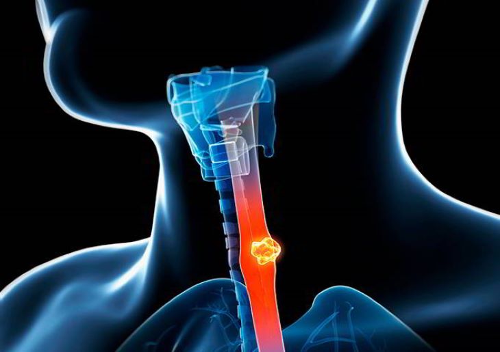 Trào ngược dạ dày có thể gây ung thư thực quản
