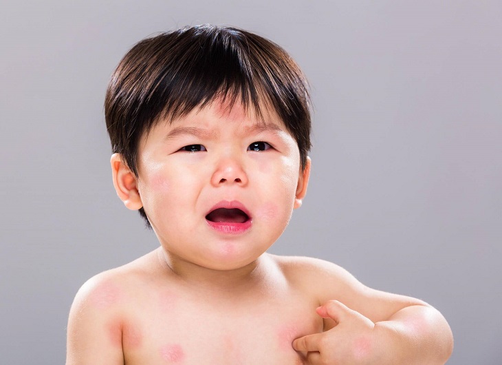 Làn da của trẻ dễ dàng bị tác động bởi nhiệt độ cao