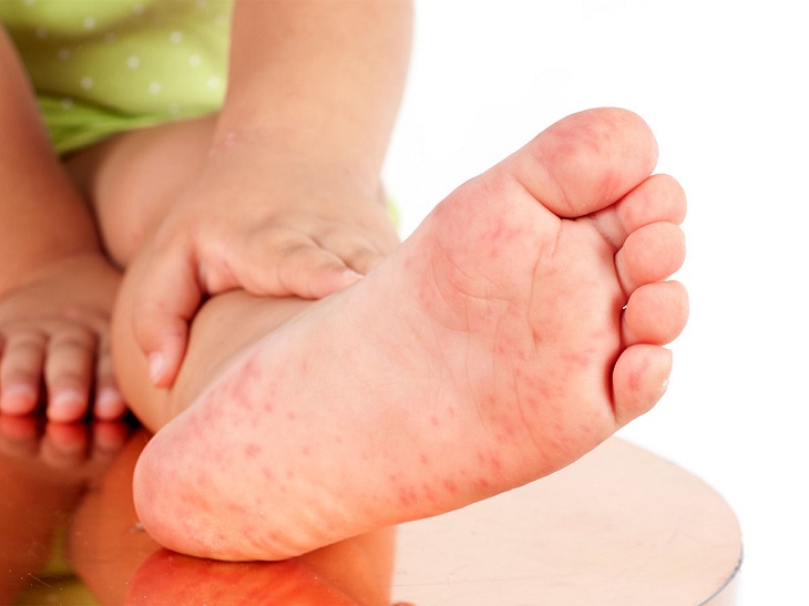 Trẻ nổi mẩn ngứa khắp người do ban đỏ hoàn toàn có thể tự khỏi