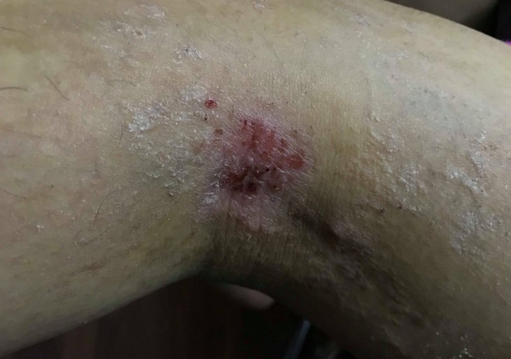 Viêm da cơ địa ở các giai đoạn khác nhau thì biểu hiên ra ngoài khác nhau