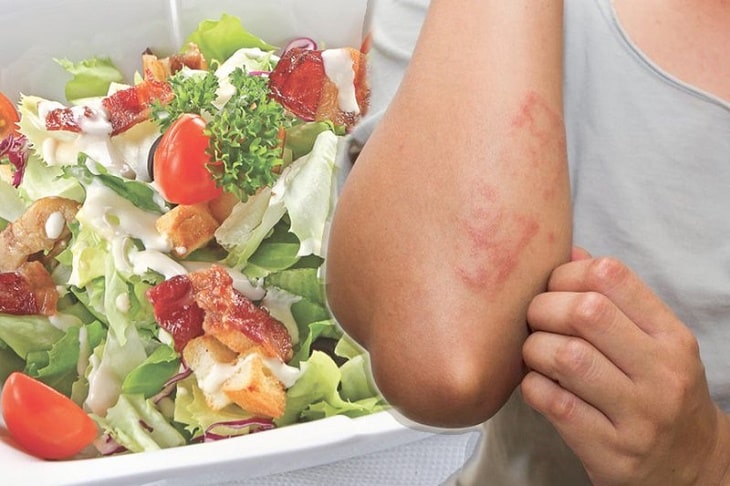 Viêm da cơ địa ở người lớn nên ăn gì, kiêng gì tốt?