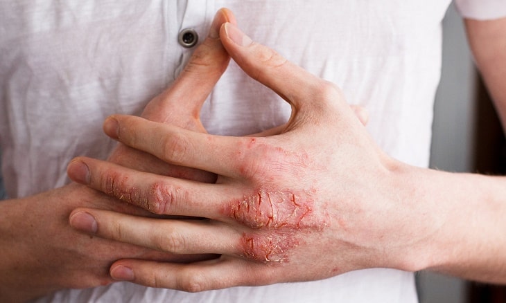 Không nên gãi ngứa khiến da bị tổn thương