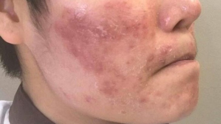Viêm da cơ địa tái đi tái lại là tình trạng da bị viêm dẫn đến mãn tính