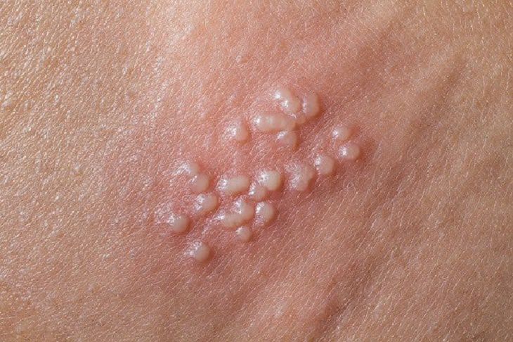 Mụn rộp sinh dục có thể mọc ở bao quy đầu
