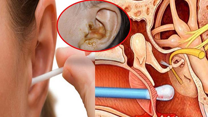 Lưu ý khi vệ sinh tai cần cẩn thận tránh làm thủng màng nhĩ