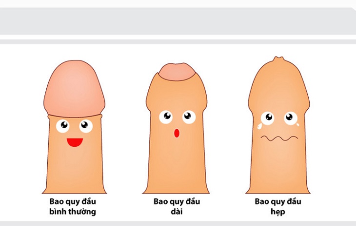 Bao quy đầu hẹp, dễ viêm