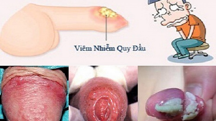 Hình ảnh nổi mẩn đỏ ở bao quy đầu do mắc bệnh viêm nhiễm
