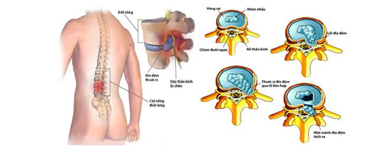Thoát vị đĩa đệm khiến người bệnh chịu nhiều đau đớn từ âm ỉ đến dữ dội.
