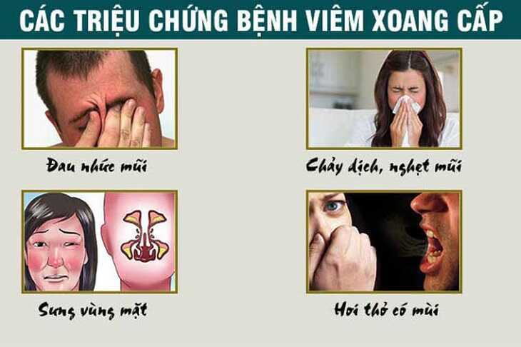 Viêm xoang cấp và các triệu chứng