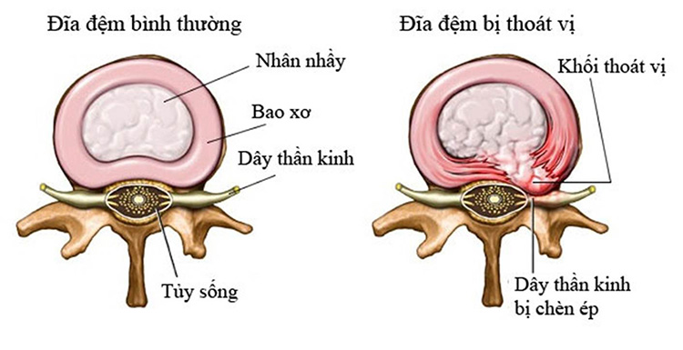 Thoát vị đĩa đệm là tình trạng nhân nhầy tràn ra chèn ép lên rễ thần kinh.