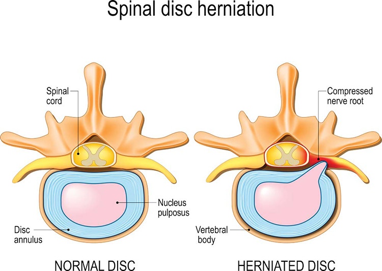 Thoát vị đĩa đệm là tình trạng nhân nhày tràn ra ngoài chèn ép dây thần kinh và ống sống