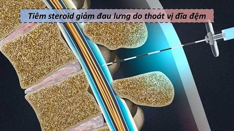 Tiêm ngoài màng cứng là liệu pháp đưa thuốc Steroid vào không gian xung quanh tủy sống.