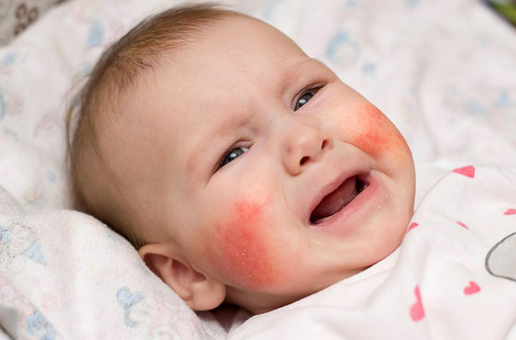 Trẻ sinh đôi cùng trứng có tỉ lệ mắc bệnh nhiều hơn sinh đôi khác trứng
