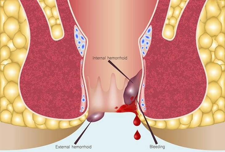 Trĩ chảy máu là hiện tượng gì?