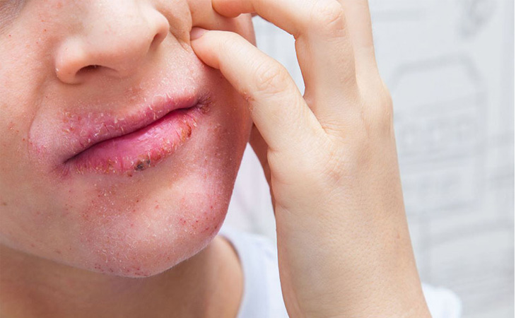 Biểu hiện rõ nét nhất của bệnh chính là đỏ, rát kèm ngứa ngáy
