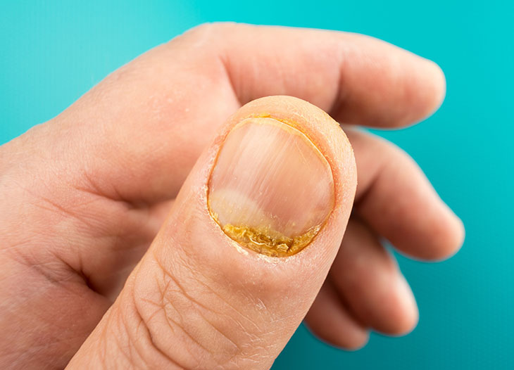 Móng tay bị vảy nến giai đoạn đầu