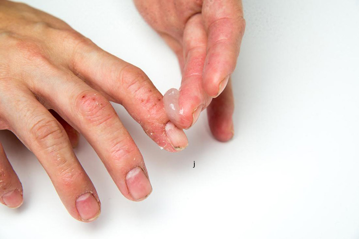 Bôi thuốc trị vảy nến móng tay