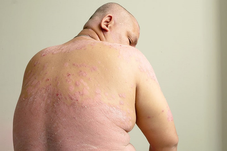 Béo phì là một trong những nguyên nhân gây bệnh vảy nến ở nách