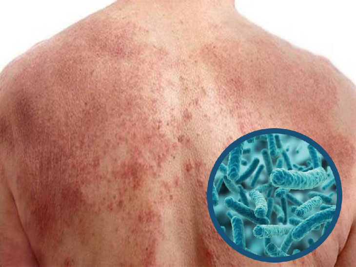Điều trị không đúng cách có thể dẫn đến nhiễm trùng, bội nhiễm nguy hiểm