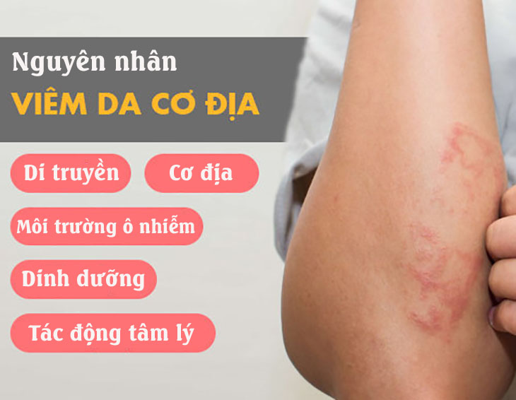 Nguyên nhân chính gây ra viêm da cơ địa