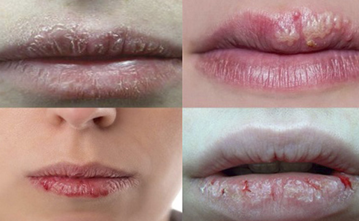 Hình ảnh mô tả các cấp độ của bệnh viêm da cơ địa xuất hiện ở môi