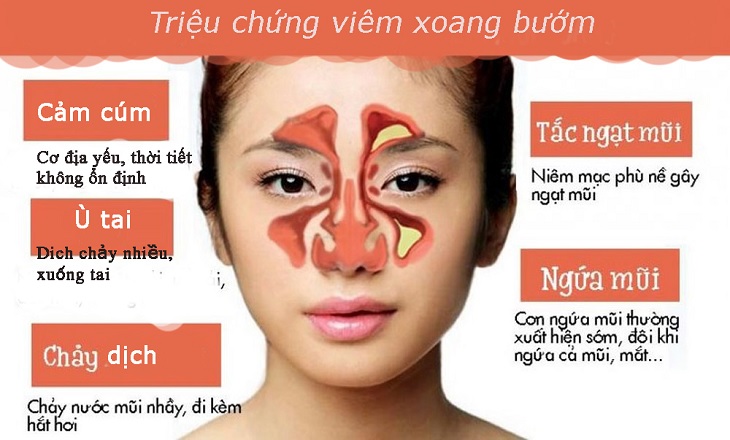 Một số triệu chứng thường gặp ở viêm xoang bướm