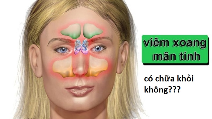 Viêm xoang mãn tính có chữa được không