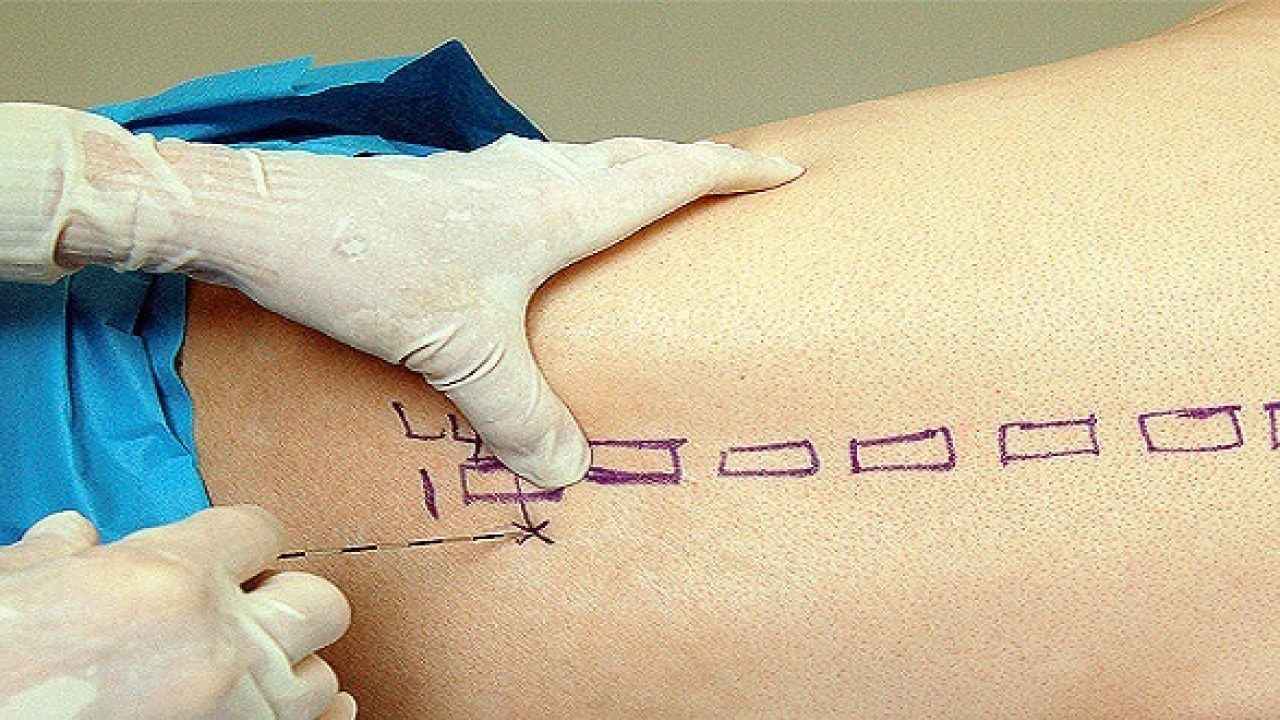 Xác định vị trí tiêm chính xác để hạn chế rủi ro không muốn xảy ra.