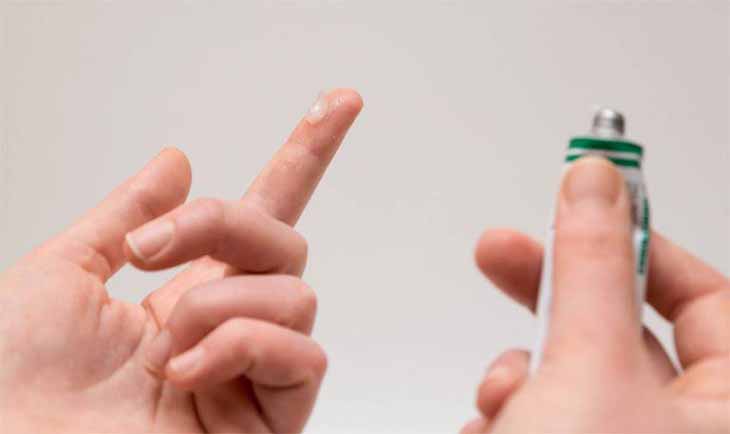 Thuốc trị vảy nến Axit Salicylic rất lành tính Thuốc trị vảy nến Axit Salicylic rất lành tính