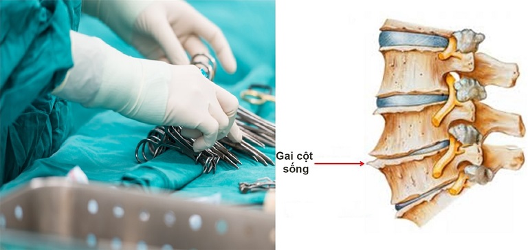 Phẫu thuật là được chỉ định trong phác đồ điều trị thoái hóa cột sống giai đoạn 4