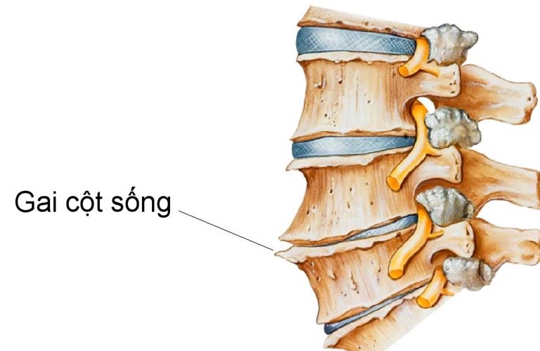 Thoái hóa cột sống gây hình thành gai xương