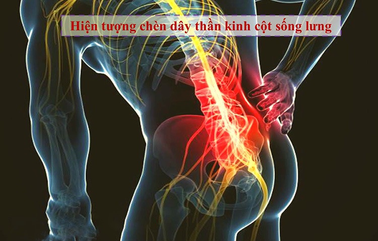 Thoái hóa cột sống chèn dây thần kinh cột sống lưng khiến người bệnh khó khăn khi xoay vặn mình