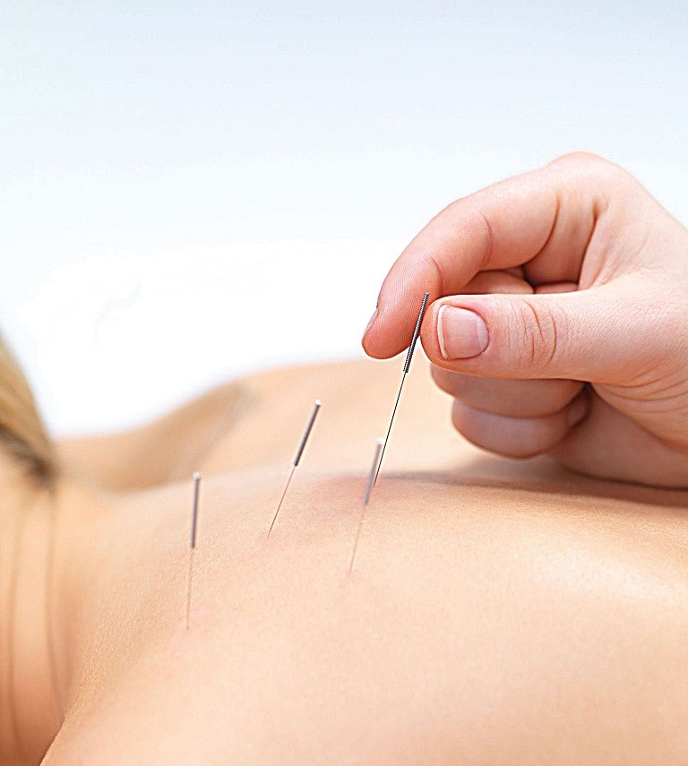 Thoái hóa cột sống có châm cứu được không là thắc mắc của nhiều người bệnh