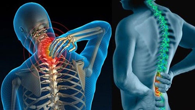 Thoái hóa cột sống chèn dây thần kinh là tình trạng cột sống bị sưng viêm chèn ép lên dây thần kinh xung quanh