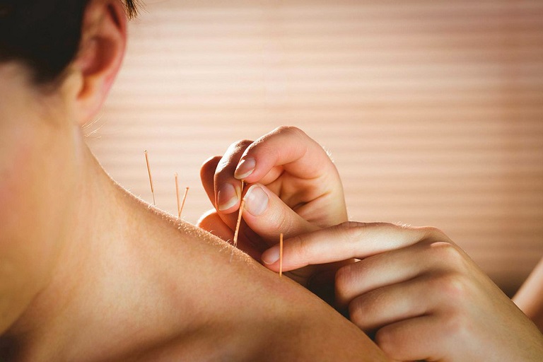 Châm cứu là phương pháp chữa thoái hóa đốt sống cổ hiệu quả