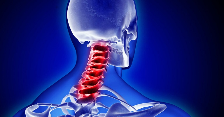 Bài thuốc số 2 phù hợp với người bệnh bị gai đốt sống cổ Bài thuốc số 2 phù hợp với người bệnh bị gai đốt sống cổ