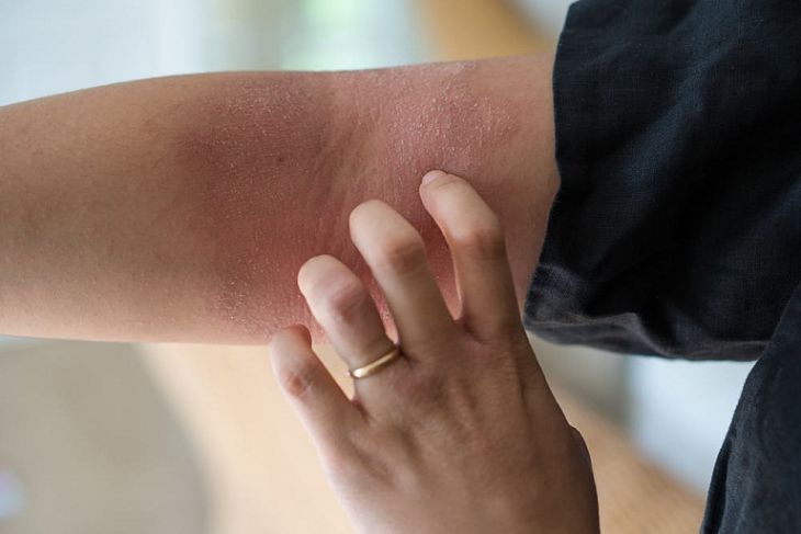 Bệnh viêm da cơ địa sau sinh