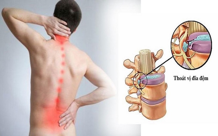 Thoát vị đĩa đệm chữa được không phụ thuộc vào mức độ nghiêm trọng của bệnh