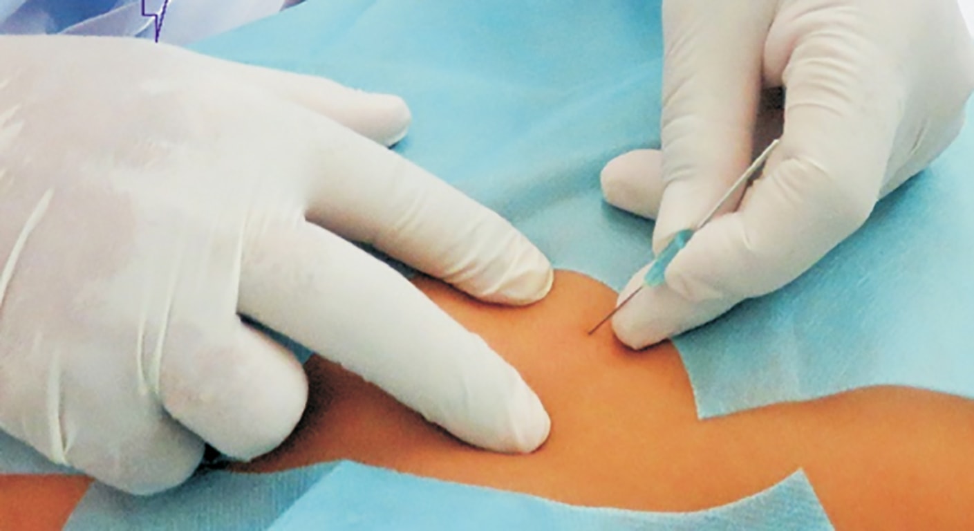cấy chỉ chữa khớp gối