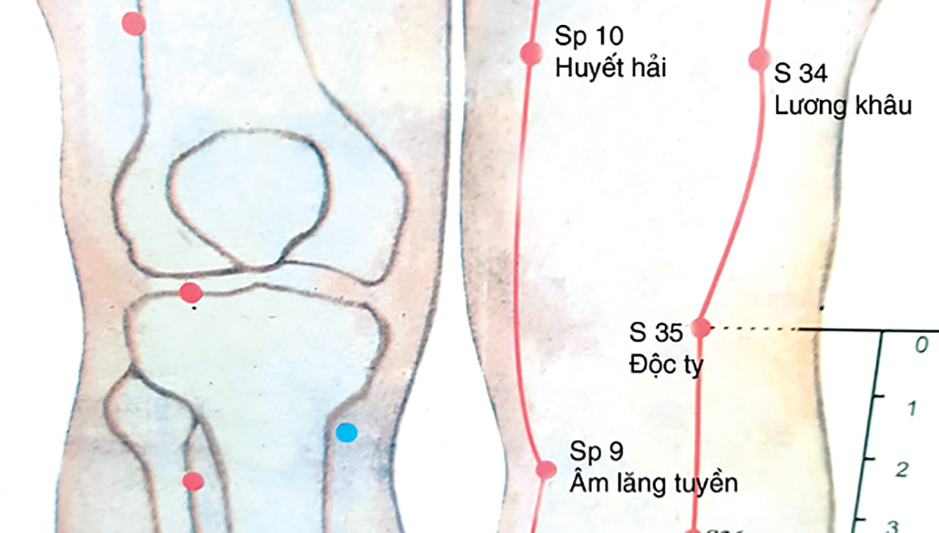 Các huyệt cấy chỉ chữa hoái hóa khớp gối