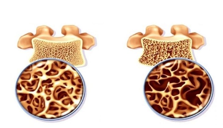 Phân loại bệnh loãng xương