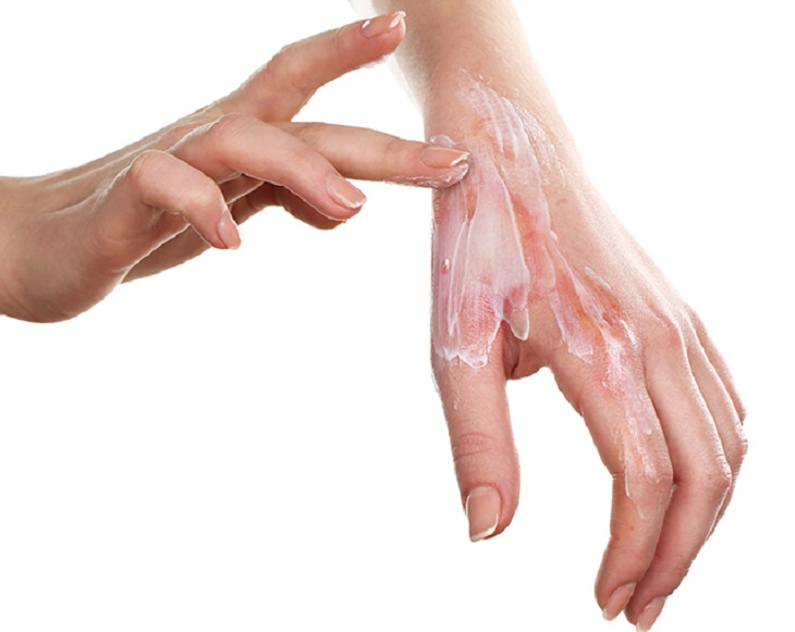 Người bệnh có thể kết hợp thuốc bôi điều trị tại chỗ và thuốc uống