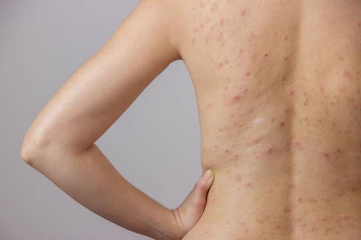 Viêm da tiết bã có tự hết không? Câu trả lời là không