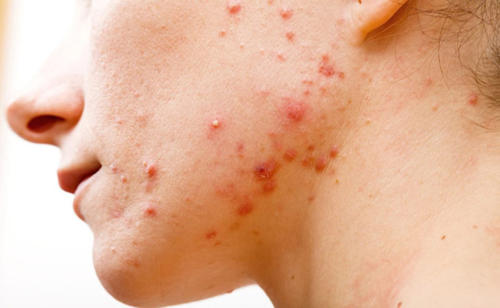 Trị mụn nhọt ngoài da bằng cách bôi bên ngoài