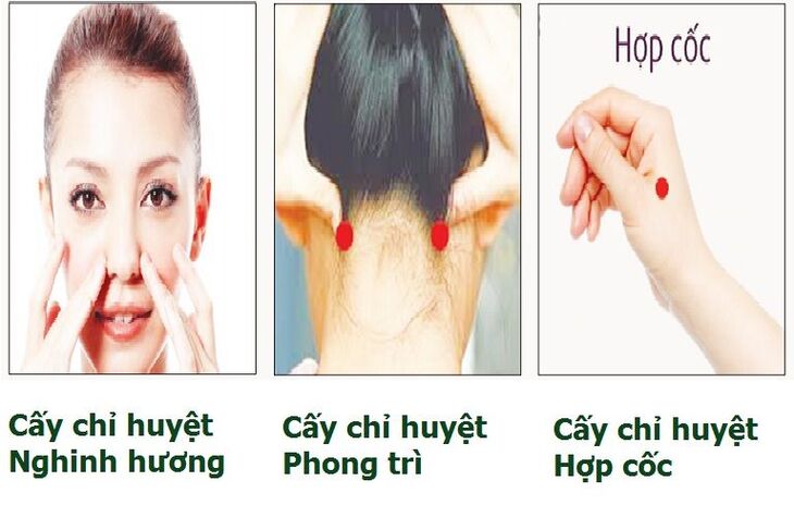 Cấy chỉ chữa bệnh viêm xoang mũi an toàn, hiệu quả, không xâm lấn sâu