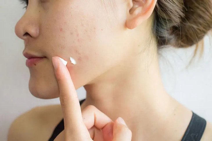 Các sản phẩm chuyên dụng để điều trị da khô mụn