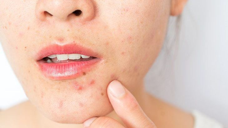 Phương pháp điều trị da khô mụn